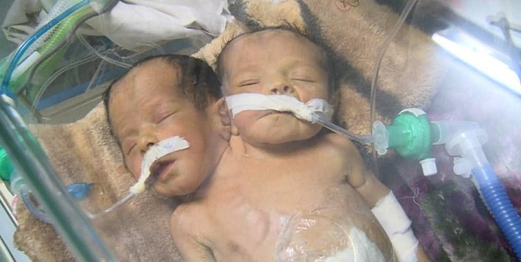 مرگ دوقلوهای به هم‌چسپیده یمنی به دلیل لجاجت عربستان سعودی